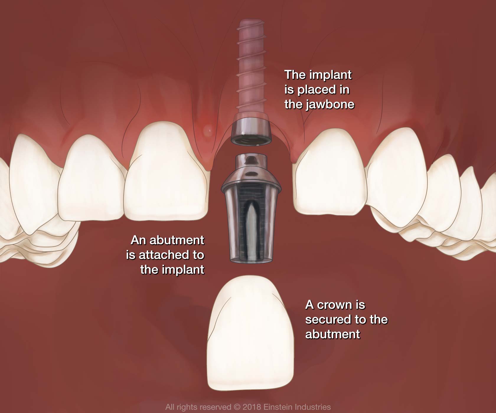 The implant is placed in the jawbone. An abutment is attached to the implant. A crown is secured to the abutment.